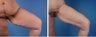 Thighplasty
