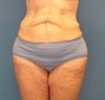 Inner thigh lift