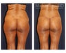 Lower Body Lift
