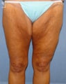 Thigh Lift