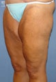 Thigh Lift