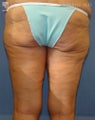 Thigh Lift