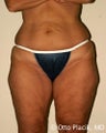 Thigh and Buttock Lift