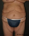 Thigh Lift