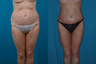 Thigh Lift