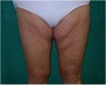 Thigh lift
