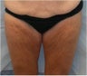 Thigh lift