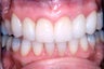Combination of crowns, veneers, and gum surgery