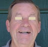 Dentures