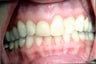 Combination of crowns, veneers, and gum surgery