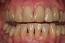 alloderm tissue graft