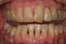alloderm tissue graft