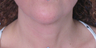 TriPollar
