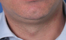 TriPollar