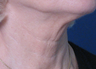 TriPollar