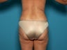 Liposuction of The Hips and Outer Thighs