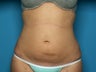 Liposuction of Abdomen, Hips, and Thighs
