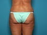 Liposuction after Age 50