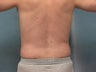 Liposuction