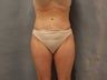 Liposuction