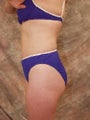 Liposuction