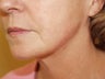 Liposuction