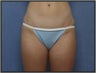 Tumescent Liposuction