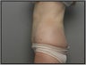 Tumescent Liposuction