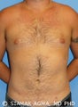 Tumescent liposuction