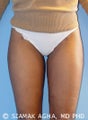 Liposuction