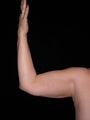 Liposuction of upper arm