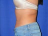 Tumescent Liposuction
