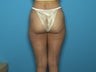 Liposuction of Hips and Lateral Thighs