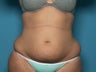 Liposuction of Abdomen, Hips, and Thighs