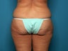 Liposuction after Age 50