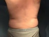 Liposuction