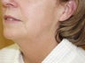 Liposuction