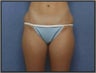 Tumescent Liposuction
