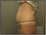 Tumescent Liposuction
