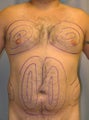 Tumescent liposuction