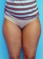 Liposuction