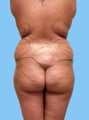 Liposuction