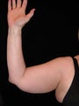 Liposuction of upper arm