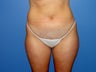 Tumescent liposuction before and after