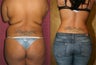 Tumescent Liposuction