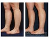 Liposuction