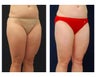 Liposuction