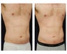 Liposuction