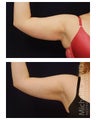 Liposuction