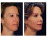 Chin Liposuction